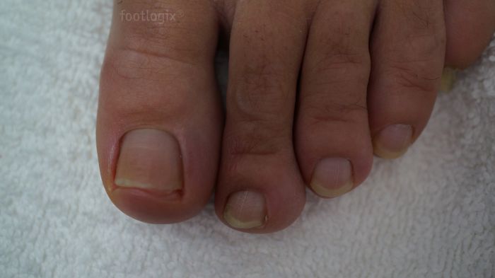 Footlogix Toenail Tincture Spiraleen Spray