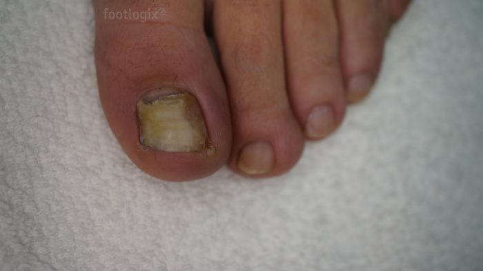 Footlogix Toenail Tincture Spiraleen Spray